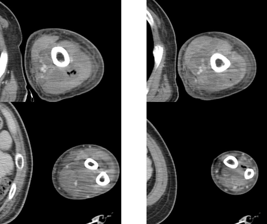 Figure 3 for case Diabetic myonecrosis with cellulitis